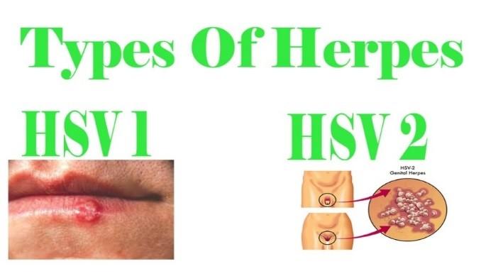 https://i.ytimg.com/vi/q_j_nkkoc QE/maxresdefault.jpg Simplexvirus (HSV-1, 2) Prim. infekce HSV-1: gingivostomatitida, keratokonjunktivitida, meningoencefalitida aj.