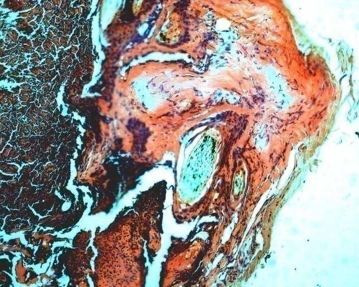 Detail chlupaté rány: zvětšení 10x10, barvivo hematoxylin eosin Na tomto obrázku je