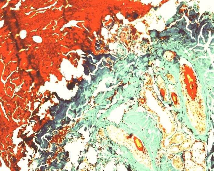 Detail chlupaté rány: zvětšení 10x10, barvivo Massonův zelený trichrom Na tomto detailu