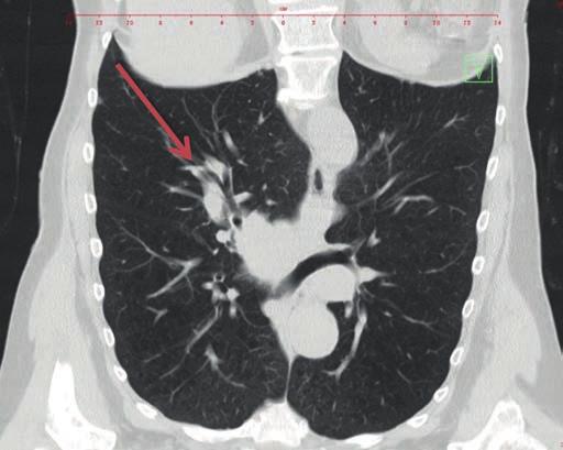 V diferenciální diagnostice bylo vzhledem k euvolemické hyponatremii pomýšleno na SIADH, hypokortikalismus a hypotyreózu.