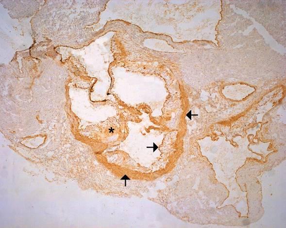 5.2. VÝSLEDKY IMUNOHISTOCHEMICKÉ ANALÝZY 5.2.1.