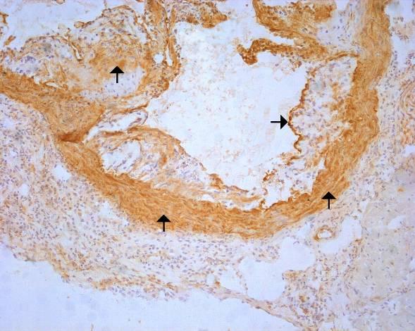 Obr.8: Imunohistochemické barvení VCAM -1; zvětšeno 100x.