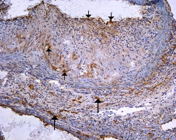 Obr.10: Imunohistochemické barvení endoglinu; zvětšeno 100x.