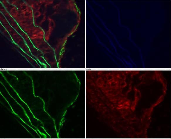5.2.3. Kolokalizace endoglinu a VCAM -1 Fluorescenční barvení demonstrující barvení VCAM-1 a endoglinu potvrdilo expresi obou markerů popsanou ve světelné mikroskopii.