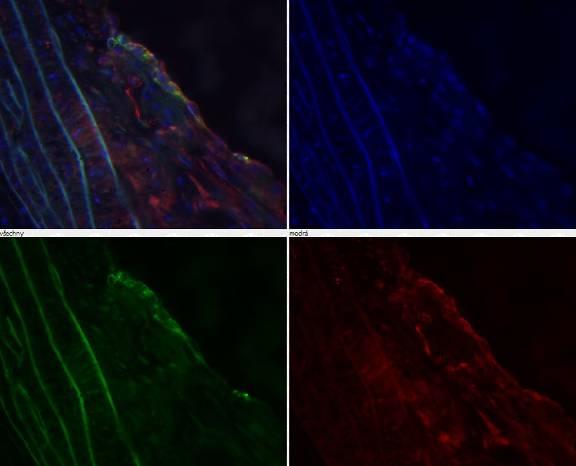 Obr.12: Imunohistochemické barvení endoglinu a VCAM-1 pomocí fluorescenční mikroskopie, kolokalizace obou antigenů; zvětšeno 400x.