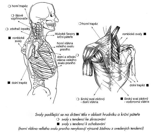 Obrázek 1 Svalová dysbalance typu horního zkříženého syndromu Zdroj: Tlapák, 2004 1.6.4 Dolní zkřížený syndrom Při dolním zkříženém syndromu je typické zkrácení svalů v oblasti kyčelního kloubu.