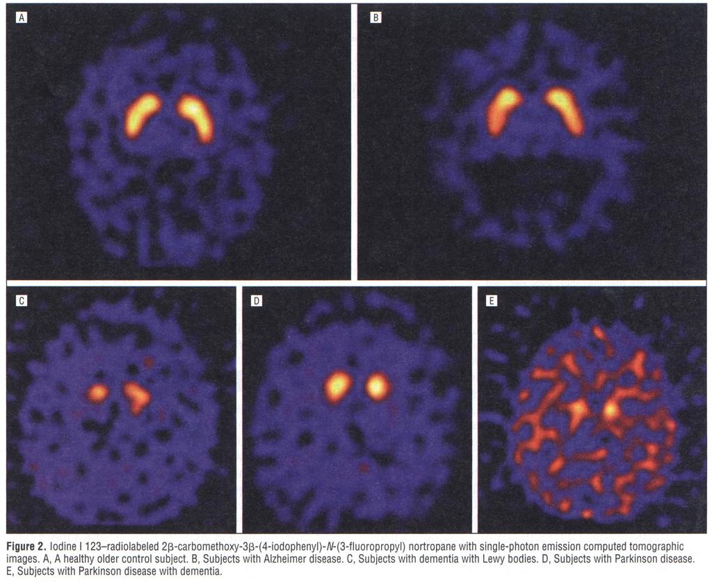 DAT SCAN: DLB (patologické vychytávání radiofarmaka) oproti AN radiofarmaka (normáln lní vychytávání radiofarmaka) McKeith et al, Lancet