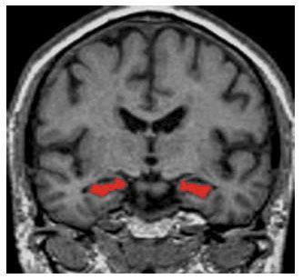 MRI mozku u AN MRI: senzitivita 80-94%, specificita 60-100% Kopíruj rují