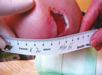 20 Terapie diabetické nohy Syndrom diabetické nohy terapeutické přístupy Obr. 1 Kateřina Burešová podiatrická ambulance, Diabetologické centrum, II. interní klinika, FN U sv.