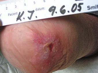Stav po amputaci levé dolní končetiny (LDK) pod kolenem pro diabetickou gangrénu v roce 2000. Do naší ambulance přišel poprvé 30. 7.