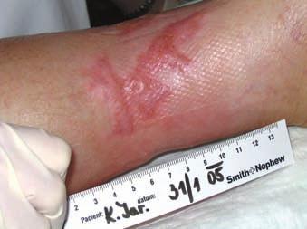 ), v průměru 5 cm, a v okolí četné hyperkeratózy. První návštěva v naší ambulanci byla 10. 2. 2004. Od 7. 9.