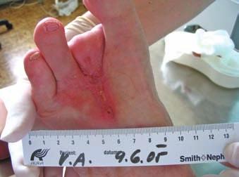 Pacient byl objednán k angiografii, dostal ATB. 5. 1. 2005 byla provedena angiografie, kde byly prokázány těžké stenózy. 10. 1. byla provedena angioplastika (PTA) se zavedením stentu.