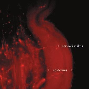 5: Mikroskopický nález u pacienta ze skupiny DM epidermis bez tenkých nervových vláken Literatura Barohn, R. J. Intraepidermal nerve fiber assessment. A new window on peripheral neuropathy.