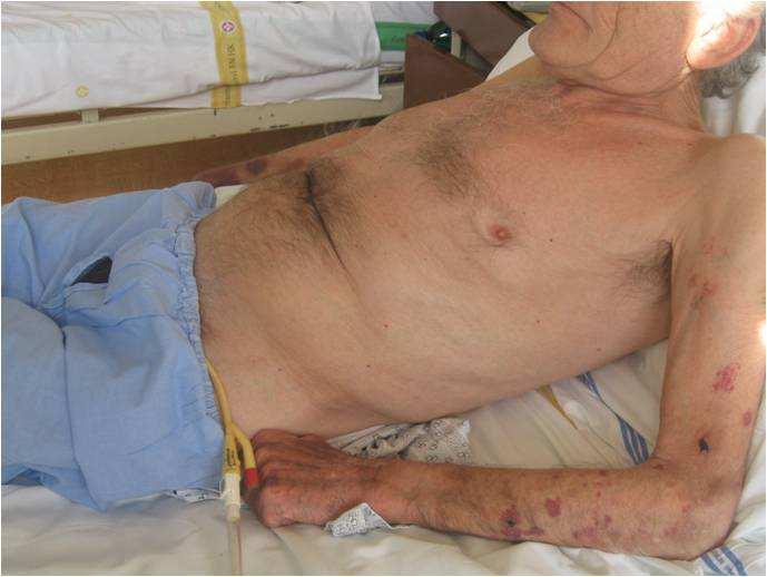 ischemická choroba srdeční, některé nádory, diabetes mellitus či vředová choroba gastroduodena (Obrázky 3 A-B).