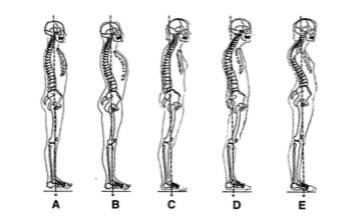 Postoje B E jsou ukázkou odchylek od optimální, přirozené pozice. B je vyobrazením hyperlordózy páteře, C zobrazuje plochá záda, D znázorňuje kyfózu a E hyperkyfolordotický typ páteře.