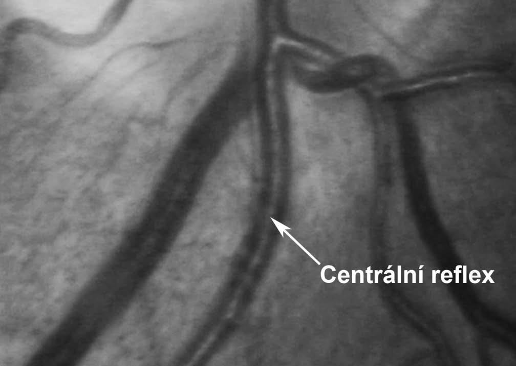Obr. 6: Detail cévy s centrálním reflexem Cévní struktury jsou z anatomického hlediska rozděleny na tenčí tepny