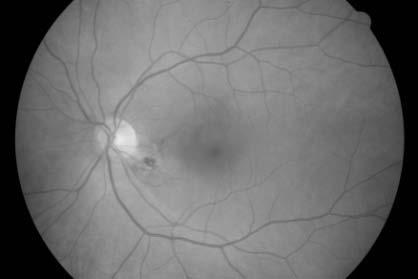 2: Rozdělení snímků v nové databázi Skupina Počet snímků Zdravé oči 15 Diabetická retinopatie 15 Glaukom 18 Celkem 48 Vyšší kvality hodnocení metody lze dosáhnout porovnáním výsledků metody s více