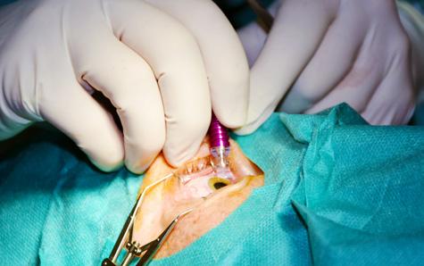 Z medicínského hlediska jde o onemocnění, při kterém dochází k odumírání nervových vláken zrakového nervu, což se projevuje nejdříve drobnými výpadky v zorném poli a může skončit až jeho ztrátou.