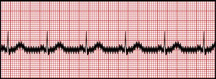 4 EKG signál rušení a srdeční arytmie Při snímání EKG signálu nikdy nedostaneme dokonale čistý signál bez rušení.