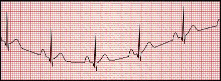 *Pozn.: Na Obr. 4 vidíme EKG signál postižený síťovým šumem 60Hz. V evropských zemích je kmitočet elektrického proudu v síti 50Hz, v zemích USA je tento kmitočet 60Hz. 4.1.