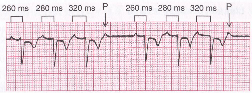 Pro jeho potlačení lze použít dolní propusť s mezní frekvencí 35 45Hz, je však třeba počítat se zkreslením signálu ořezání hran v QRS komplexech. S omezeným efektem lze použít adaptivní filtraci.