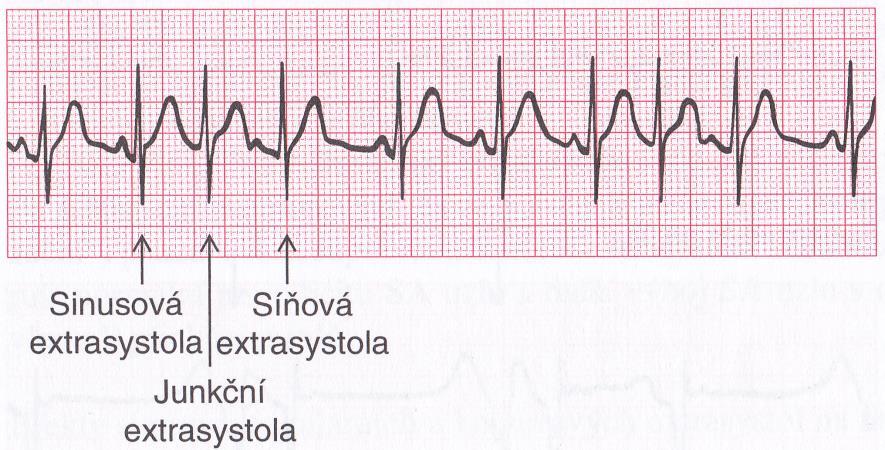 (či trojnásobku) P vln než komplexů QRS [9]. Obr.