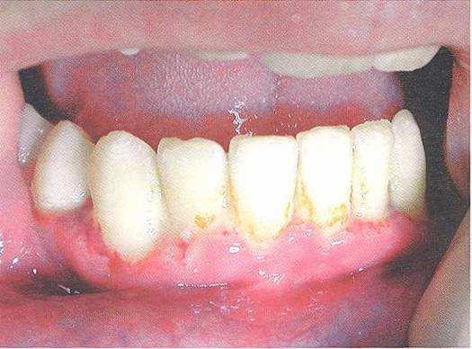 se šíří na gingivu a alveolární sliznici (tzv. ulcerózní gingivostomatitida) i do hloubky na alveolární kost (Ryšková, 2004). Obr.