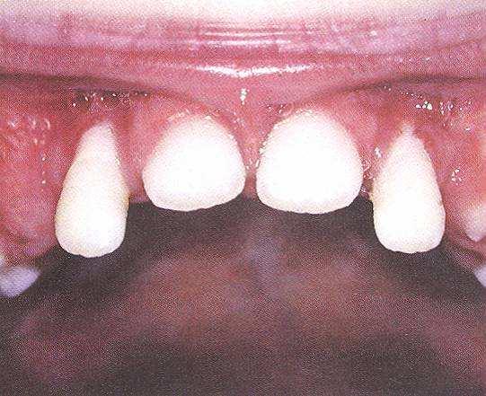 formě) a bakterie tvořící tzv. červený komplex - Porphyromonas gingivalis, Treponema denticola, Tannerella forsythensis (při generalizované formě).