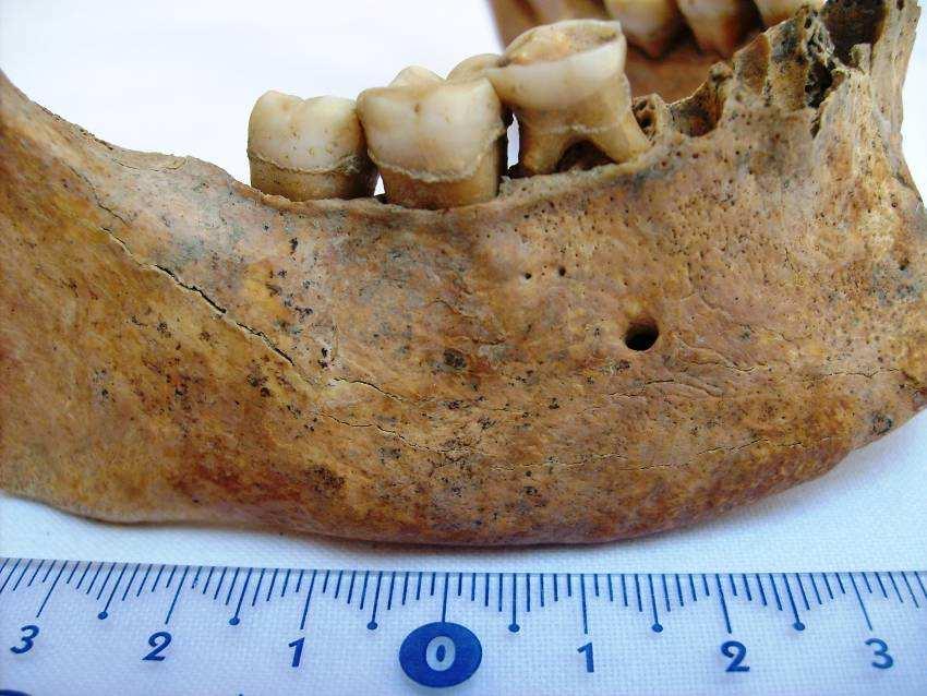 Příloha 2: Mandibula se zuby pokrytými zubním kamenem, stadium I