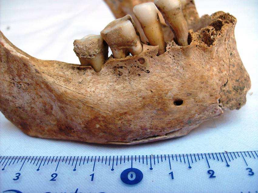 Příloha 4: Mandibula se špičákem pokrytým zubním kamenem, stadium
