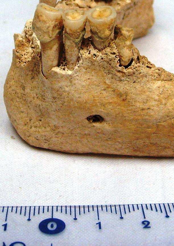 autorka Příloha 5: Mandibula s moláry pokrytými zubním kamenem,