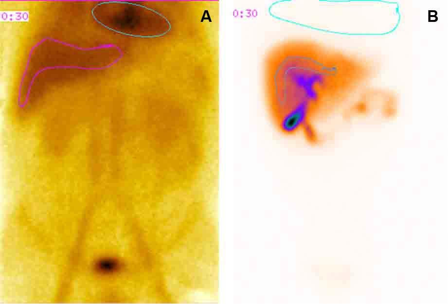 Laboratorní diagnostika žloutenek KAPITOLA 24 Obrázek 24.5 Cholescintigram u Rotorova syndromu (A). Panel B ukazuje normální nález bez známek poruchy jaterní chromosekrece.