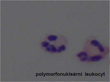 Cytochemické vyšetření mozkomíšního moku KAPITOLA 31 Nádorové buňky Obrázek 31.5 neco Nádorové buňky v mozkomíšním moku mnohem častěji pochází z extrakraniálních nádorů než intrakraniálních.