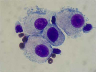 Cytochemické vyšetření mozkomíšního moku pro neinfekční onemocnění kompresivní syndrom, autoimunitní onemocnění. Nález je také charakteristický pro konečnou fázi zánětu.