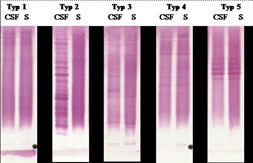 Cytochemické vyšetření mozkomíšního moku 4. typ: identické OP v likvoru a séru (paraneoplastické syndromy,sle) 5.