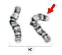 strukturní přestavby inzerce inzerce úseku chromosomu č.