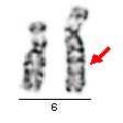 strukturní přestavby duplikace duplikace nadbytečný chromosomový segment, který způsobuje vznik nebalancovaného karyotypu