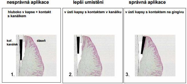 Obrázek 26 Typy aplikací a správného umístění sondy v parodontálním chobotu OzoneDTA (24) 3.