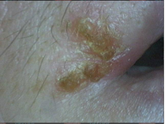 Ošetření probíhalo za pomocí přístroje dentálního generátoru ozónu OzoneDTA. Již v první návštěvě proběhla aplikace ozónu pomocí skleněné sondy č.3. ve frekvenci 2x 30 sekund.