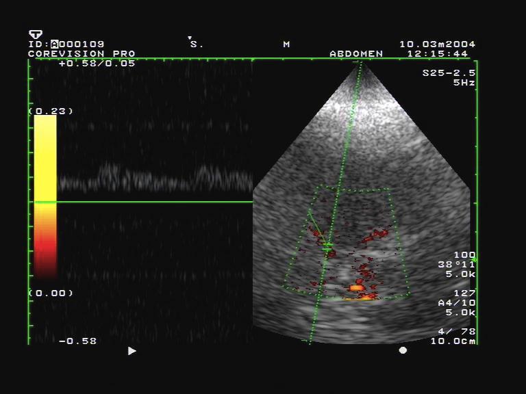 TCCS - Hemodynamické