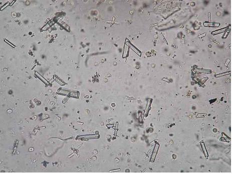 Kyselina močová Kyselina močová je konečným metabolickým produktem purinů. Při ph moče 5,0 se v moči vyskytuje jako méně rozpustná látka než v séru, proto ji v moči nacházíme ve formě krystalů.