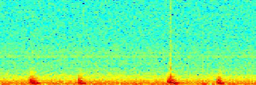 Frequency Mitrální stenóza.5 -.5-1.2.4.6.8 1 1.2 1.4 1.6 1.
