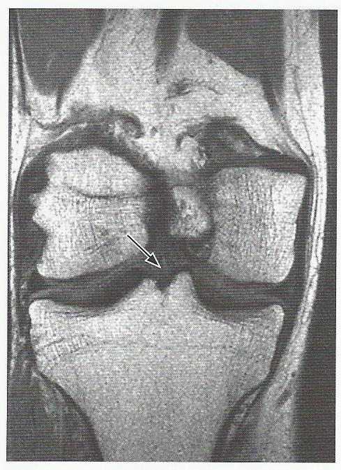 Příloha 3 Wibergova a Baumgartlova klasifikace tvaru čéšky Zdroj: Jan Bartoníček, Jiří Heřt. Základy klinické anatomie pohybového aparátu. Praha: Maxdorf, 2004. 80-7345-017-8.