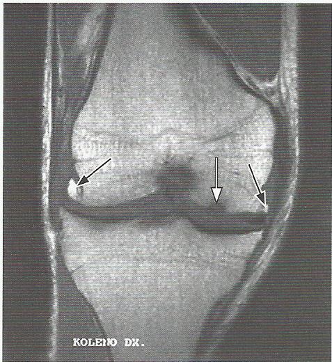 Příloha 6 Počínající osteochondronekróza mediálního kondylu femuru, v T1 obraze v koronární rovině Zdroj: Karel Trnavský, Vratislav Rybka et al. Syndrom bolestivého kolena. Praha: Galén, 2006.