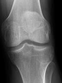 2.3.2 DIAGNÓZA RTG snímek Degenerativní změny chrupavky způsobené artrózou se dají zjistit pomocí rentgenových snímků (obr. č. 4) Na zdravém kloubu (obr.