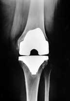 Obr. č. 5 RTG snímek kolenního kloubu po aplikaci náhrady v pohledu zpředu (vlevo) a zboku (vpravo) [15] Rizika a možné komplikace Operace náhrady kloubu není zcela bez rizika.