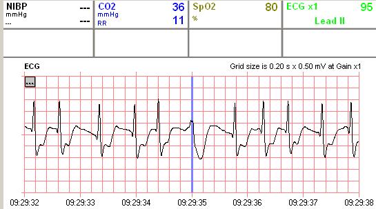 9:29:33 9:29:42 9:30:02 Obrázek 1 Fibrilace síní,