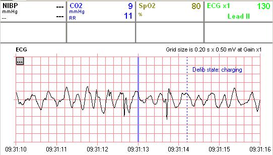 9:31:11 Obrázek 5 Fibrilace komor RR 11/min