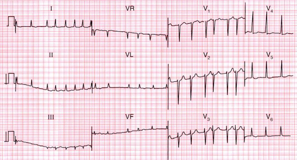 FS - EKG