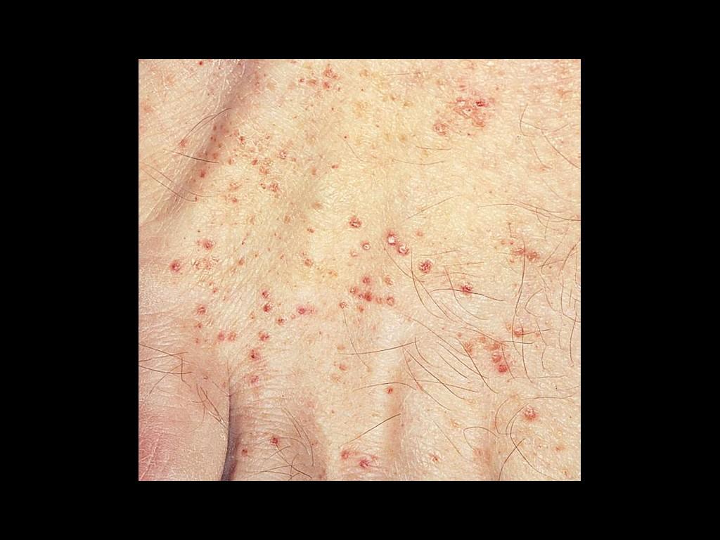 Diffuse skin involvement with petechial lesions in a patient